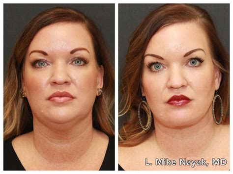 buccal fat removal phoenix|Before And After Buccal Fat Removal In Phoenix AZ.